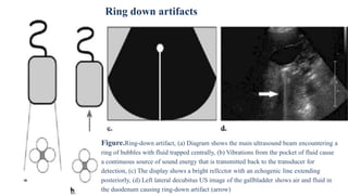 Figure.Ring-down artifact, (a) Diagram shows the main ultrasound beam encountering a
ring of bubbles with fluid trapped centrally, (b) Vibrations from the pocket of fluid cause
a continuous source of sound energy that is transmitted back to the transducer for
detection, (c) The display shows a bright rellcctor with an echogenic line extending
posteriorly, (d) Left lateral decubitus US image of the gallbladder shows air and fluid in
the duodenum causing ring-down artifact (arrow)
Ring down artifacts
 