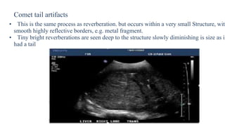 Comet tail artifacts
• This is the same process as reverberation. but occurs within a very small Structure, with
smooth highly reflective borders, e.g. metal fragment.
• Tiny bright reverberations are seen deep to the structure slowly diminishing is size as if
had a tail
 