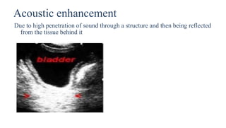 Acoustic enhancement
Due to high penetration of sound through a structure and then being reflected
from the tissue behind it
 