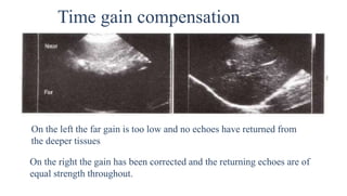 .
Time gain compensation
On the right the gain has been corrected and the returning echoes are of
equal strength throughout.
On the left the far gain is too low and no echoes have returned from
the deeper tissues
 