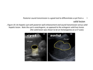 •
Posterior sound transmission is a good tool to differentiate a cyst from a
solid lesion
. Figure 19. An hepatic cyst wit...