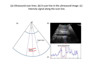 (a) Ultrasound scan lines. (b) A scan line in the ultrasound image. (c)
Intensity signal along the scan line.
 