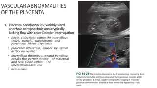 Subchorionic Infarct Ultrasound to evaluated placenta ASW.pptx