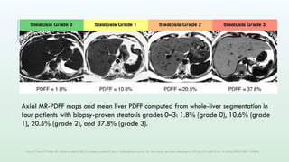 US QUANTIFICATION OF FATTY LIVER OM SS (1).pptx