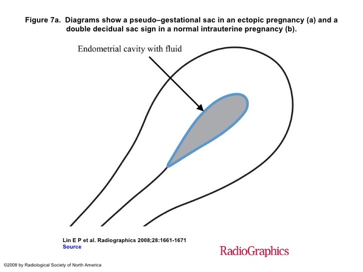 USS in Ectopic Pregnancy