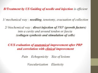 PRP Therapy for Tendonitis Fasciitis Acute Sprains and Muscular Lesions ...