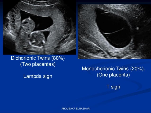 Ultrasonography of twin pregnancy SOGC GUIDELINE
