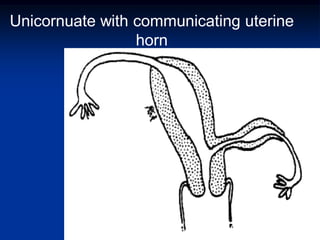 Unicornuate with communicating uterine
horn
ABOUBAKR ELNASHAR
 