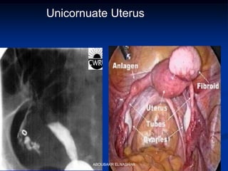Unicornuate Uterus
ABOUBAKR ELNASHAR
 
