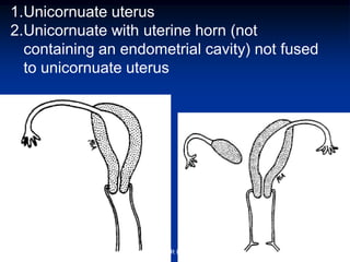 1.Unicornuate uterus
2.Unicornuate with uterine horn (not
containing an endometrial cavity) not fused
to unicornuate uterus
ABOUBAKR ELNASHAR
 