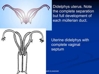 Didelphys uterus. Note
the complete separation
but full development of
each müllerian duct.
Uterine didelphys with
complete vaginal
septum
ABOUBAKR ELNASHAR
 