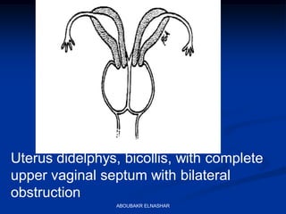 Uterus didelphys, bicollis, with complete
upper vaginal septum with bilateral
obstruction
ABOUBAKR ELNASHAR
 
