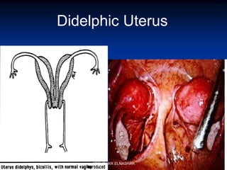 Didelphic Uterus
ABOUBAKR ELNASHAR
 