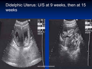 Didelphic Uterus: U/S at 9 weeks, then at 15
weeks
ABOUBAKR ELNASHAR
 