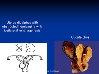 Uterus didelphys with
obstructed hemivagina with
ipsilateral renal agenesis
Ut didelphys
ABOUBAKR ELNASHAR
 
