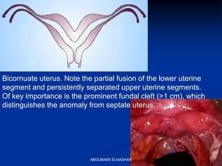 Bicornuate uterus. Note the partial fusion of the lower uterine
segment and persistently separated upper uterine segments.
Of key importance is the prominent fundal cleft (>1 cm), which
distinguishes the anomaly from septate uterus.
ABOUBAKR ELNASHAR
 
