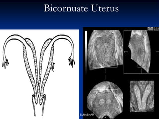 Bicornuate Uterus
ABOUBAKR ELNASHAR
 