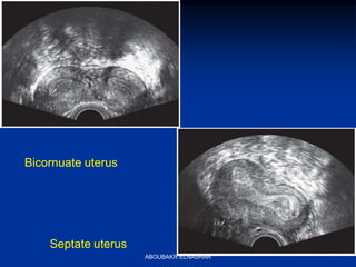 Bicornuate uterus
Septate uterus
ABOUBAKR ELNASHAR
 