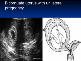 Bicornuate uterus with unilateral
pregnancy
ABOUBAKR ELNASHAR
 