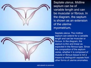 Septate uterus. Midline
septum can be of
variable length and can
be muscular or fibrous. In
the diagram, the septum
is shown as an extension
of the uterine
myometrium.
Septate uterus. The midline
septum can extend for a variable
length and can be muscular or
fibrous. In the diagram, the
septum is thin and linear as
expected in the fibrous type. Since
the composition of the septum
varies, whether it is composed of
muscle or fibrous tissue is not a
means to distinguish septate from
other forms of uterine anomalies.
ABOUBAKR ELNASHAR
 