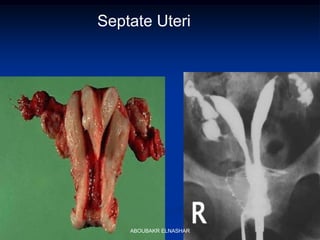 Septate Uteri
ABOUBAKR ELNASHAR
 