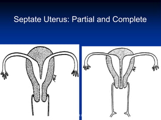 Septate Uterus: Partial and Complete
ABOUBAKR ELNASHAR
 
