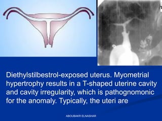 Diethylstilbestrol-exposed uterus. Myometrial
hypertrophy results in a T-shaped uterine cavity
and cavity irregularity, which is pathognomonic
for the anomaly. Typically, the uteri are
ABOUBAKR ELNASHAR
 