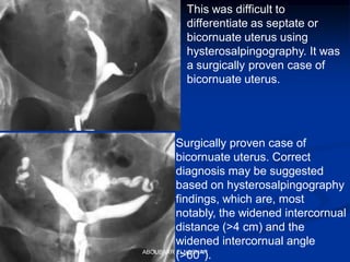This was difficult to
differentiate as septate or
bicornuate uterus using
hysterosalpingography. It was
a surgically proven case of
bicornuate uterus.
Surgically proven case of
bicornuate uterus. Correct
diagnosis may be suggested
based on hysterosalpingography
findings, which are, most
notably, the widened intercornual
distance (>4 cm) and the
widened intercornual angle
(>60°).ABOUBAKR ELNASHAR
 