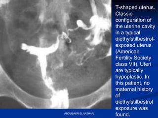 T-shaped uterus.
Classic
configuration of
the uterine cavity
in a typical
diethylstilbestrol-
exposed uterus
(American
Fertility Society
class VII). Uteri
are typically
hypoplastic. In
this patient, no
maternal history
of
diethylstilbestrol
exposure was
found.ABOUBAKR ELNASHAR
 
