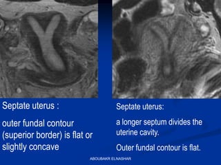 Septate uterus :
outer fundal contour
(superior border) is flat or
slightly concave
Septate uterus:
a longer septum divides the
uterine cavity.
Outer fundal contour is flat.
ABOUBAKR ELNASHAR
 