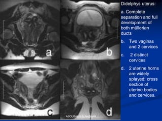 Didelphys uterus:
a. Complete
separation and full
development of
both müllerian
ducts
b. Two vaginas
and 2 cervices
c. 2 distinct
cervices
d. 2 uterine horns
are widely
splayed; cross
section of
uterine bodies
and cervices.
ABOUBAKR ELNASHAR
 
