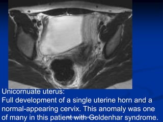 Unicornuate uterus:
Full development of a single uterine horn and a
normal-appearing cervix. This anomaly was one
of many in this patient with Goldenhar syndrome.ABOUBAKR ELNASHAR
 