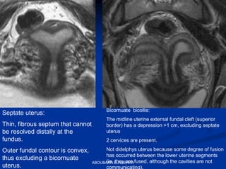 Septate uterus:
Thin, fibrous septum that cannot
be resolved distally at the
fundus.
Outer fundal contour is convex,
thus excluding a bicornuate
uterus.
Bicornuate bicollis:
The midline uterine external fundal cleft (superior
border) has a depression >1 cm, excluding septate
uterus
2 cervices are present.
Not didelphys uterus because some degree of fusion
has occurred between the lower uterine segments
(ie, they are fused, although the cavities are not
communicating).
ABOUBAKR ELNASHAR
 