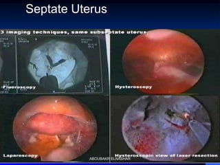 Septate Uterus
ABOUBAKR ELNASHAR
 