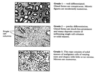 2003-10-27
CARCINOMA OF THE ENDOMETRIUM 10
 
