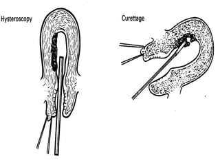 2003-10-27
CARCINOMA OF THE ENDOMETRIUM 16
 