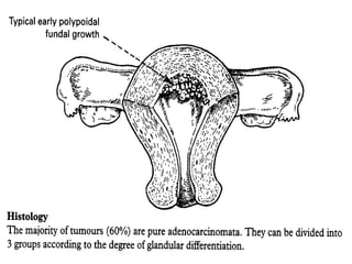 2003-10-27
CARCINOMA OF THE ENDOMETRIUM 17
 