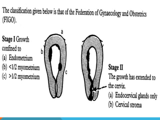 2003-10-27
CARCINOMA OF THE ENDOMETRIUM 19
 