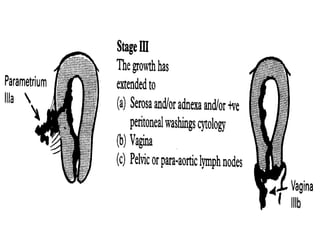 2003-10-27
CARCINOMA OF THE ENDOMETRIUM 20
 