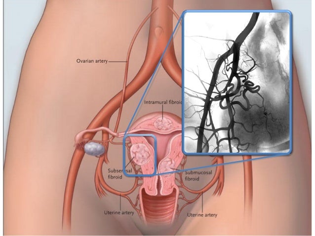 uterine artery embolization