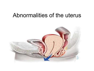 Abnormalities of the uterus
 