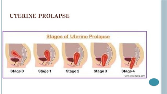 uterine-anomalies-prolapse-ovarian-cyst-pptx