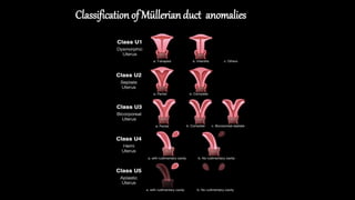 uterine anomaly UB.pptx