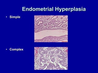 Endometrial Hyperplasia Simple Complex 