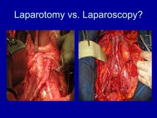 Laparotomy vs. Laparoscopy? 