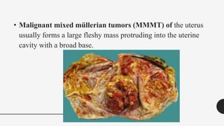 • Malignant mixed müllerian tumors (MMMT) of the uterus
usually forms a large fleshy mass protruding into the uterine
cavity with a broad base.
 