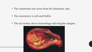 • The commonest one arises from the intramural part.
• The consistency is soft and friable.
• The cut surface shows hemorrhage and irregular margins.
 