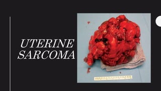 UTERINE
SARCOMA
 