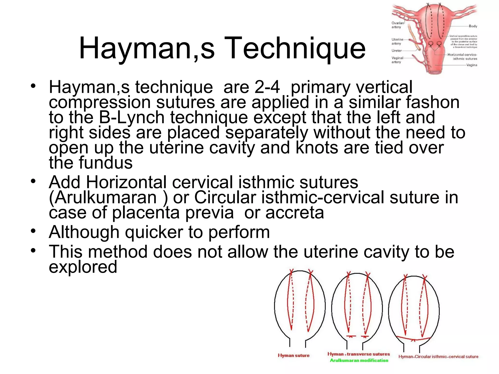 Uterine compression sutures | PPT