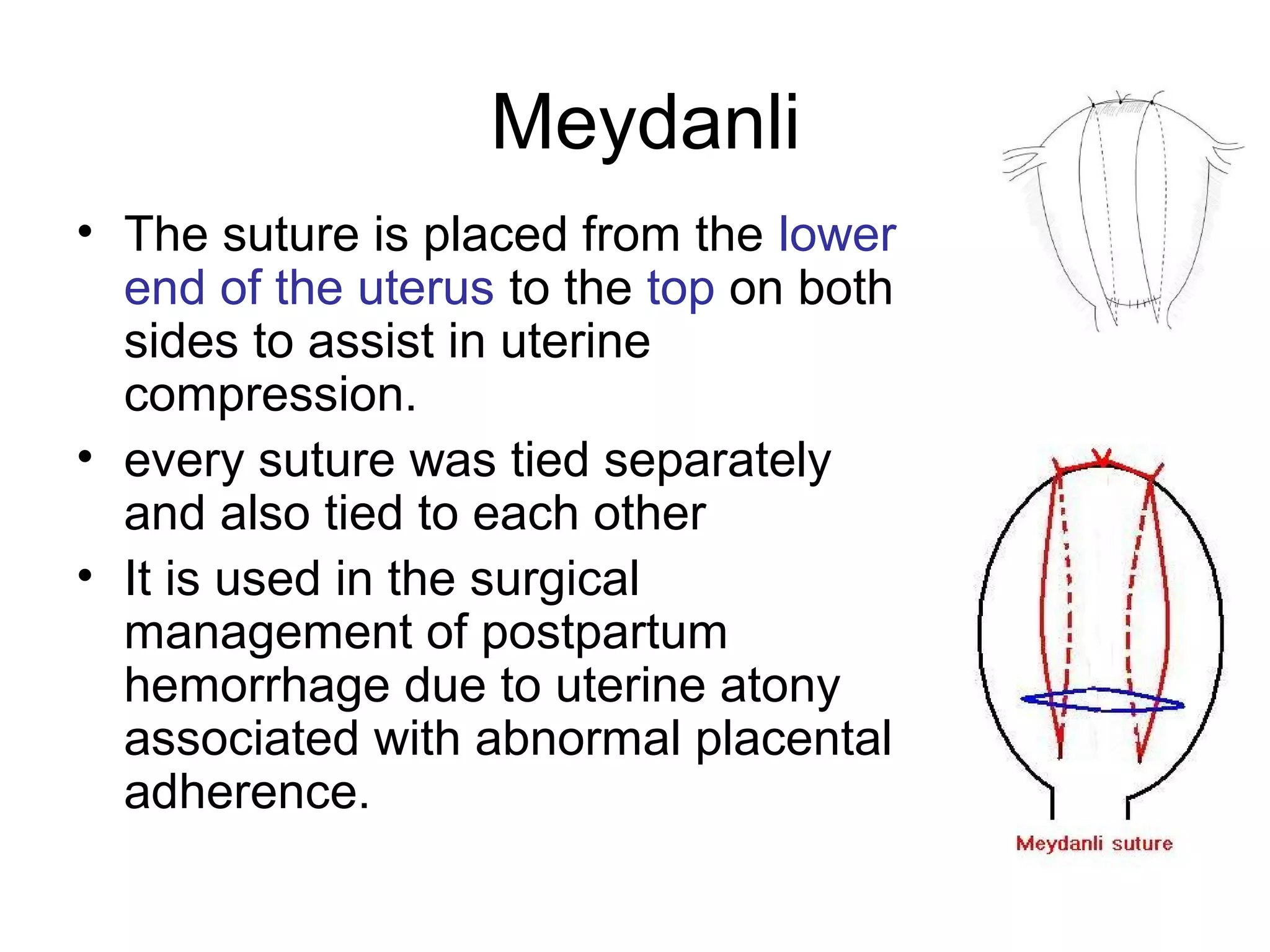 Uterine compression sutures | PPT